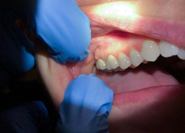 Best Emergency Dental Services for Seniors in Glencoe, AL